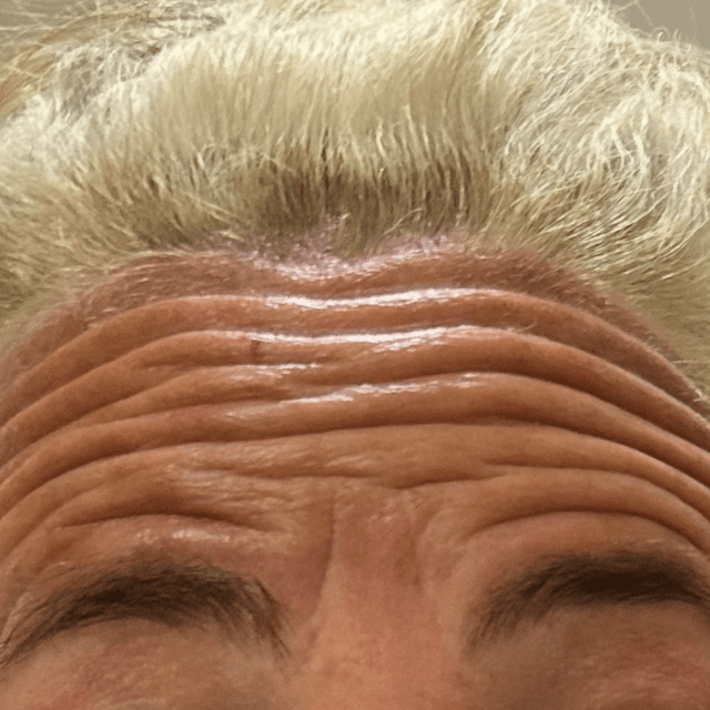 Upper Face Botox at Nueva Vida Medspa in Audubon, NJ